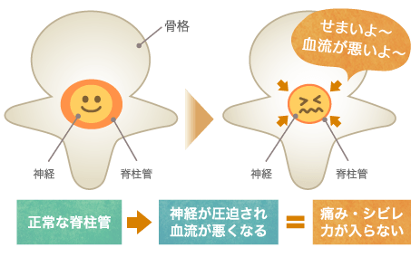 脊柱管狭窄症の原因となる正常な脊柱管と狭くなった脊柱管の比較イラスト