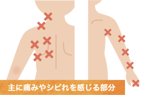 頚部脊柱管狭窄症により、首から腕にかけて放散痛を感じている男性のイラスト
