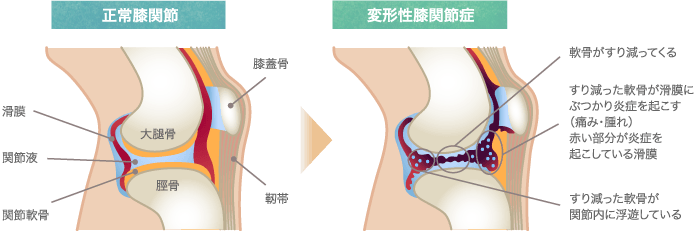 変形性膝関節症により軟骨がすり減り、滑膜の炎症が起きるメカニズムを図解