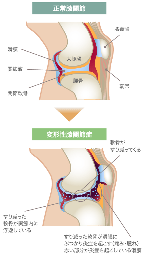 変形性膝関節症のメカニズム図解（スマホ用）
