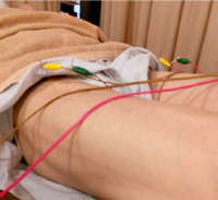 大腿四頭筋炎の治療の様子