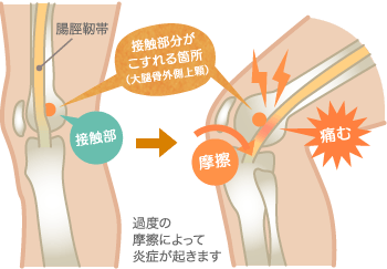 腸脛靭帯炎の原因部位の図解