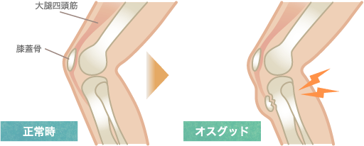 オスグッド病のメカニズム図解