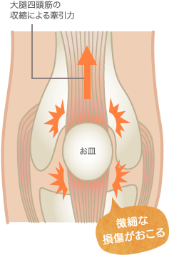 ジャンパー膝の原因部位の図解