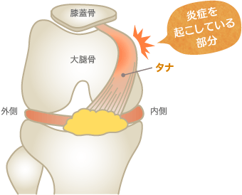 タナ障害のメカニズム図解