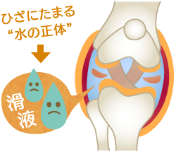 膝に水がたまるメカニズム
