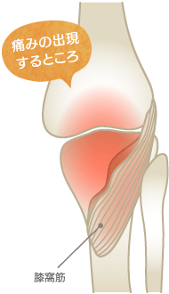 膝窩筋腱炎の痛みの部位