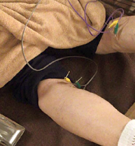 膝窩筋腱炎への治療の様子