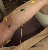 こむら返り予防の鍼治療