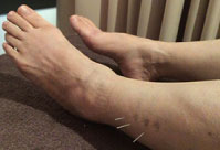 足の腱鞘炎への超音波治療