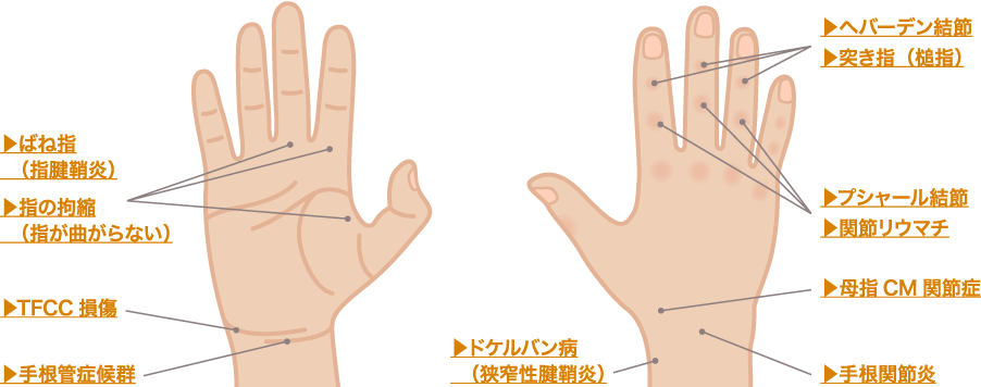 部位別で見る、手の痛み
