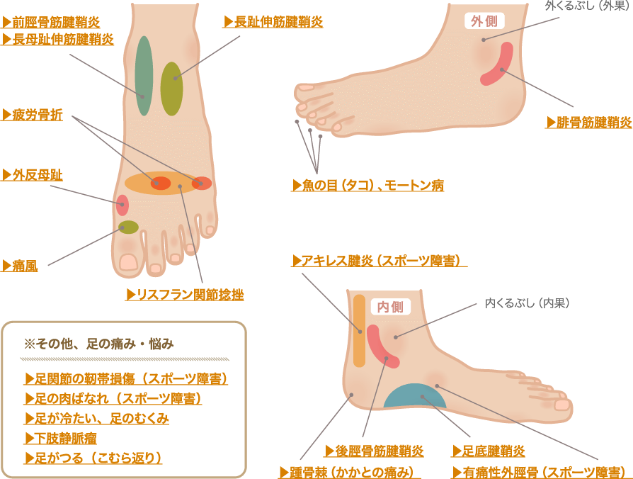 部位別で見る、足の痛み