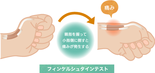 フィンケルシュタインテストの図解