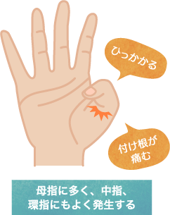 ばね指のメカニズム図解