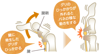 ばね指の症状チェック