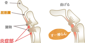 指の拘縮の症状