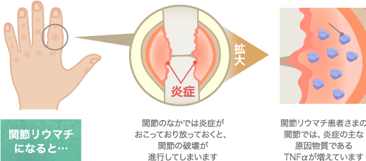 関節リウマチの症状