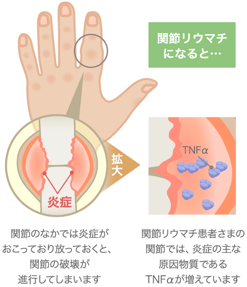 関節リウマチの症状