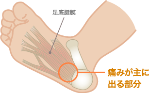 足底腱膜炎の痛みの好発部位