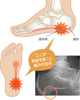 踵骨棘のレントゲンイメージ