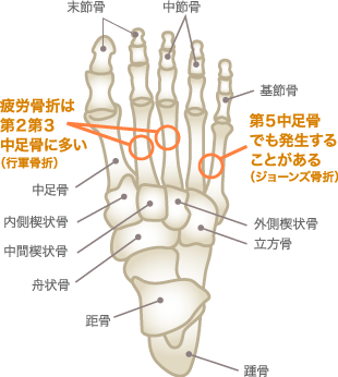 中足骨疲労骨折の好発部位