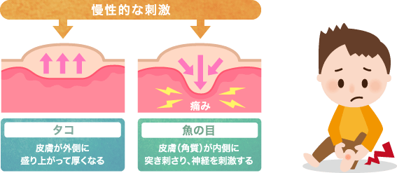 魚の目とタコの違い