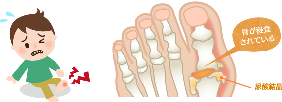 痛風発作のメカニズム