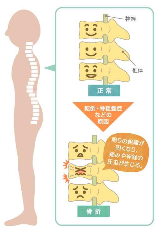 圧迫骨折の特長・症状