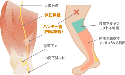 ハンター管症候群による膝からふくらはぎのしびれ原因図解