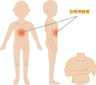 肋間神経痛による胸の痛み・みぞおちの痛みの症状部位
