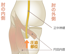 円回内筋症候群による親指・人差し指のしびれ原因図解