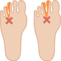 モートン病による足指の付け根の痛み・しびれ症状の図解