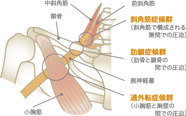 胸郭出口症候群による腕のしびれ・痛みの原因図解｜宇和島市