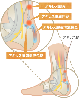 アキレス腱炎・アキレス腱周囲炎・アキレス腱滑液包炎の分類