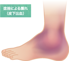足関節捻挫の特長と症状