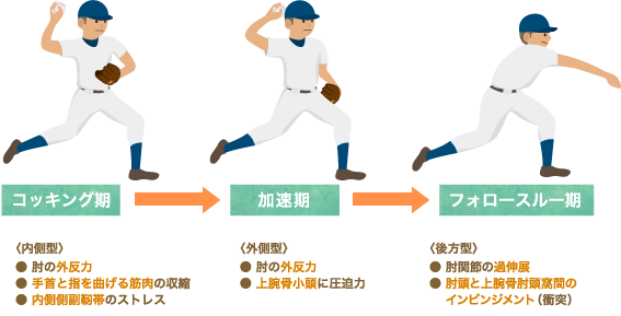 投球動作による肘にかかる負担