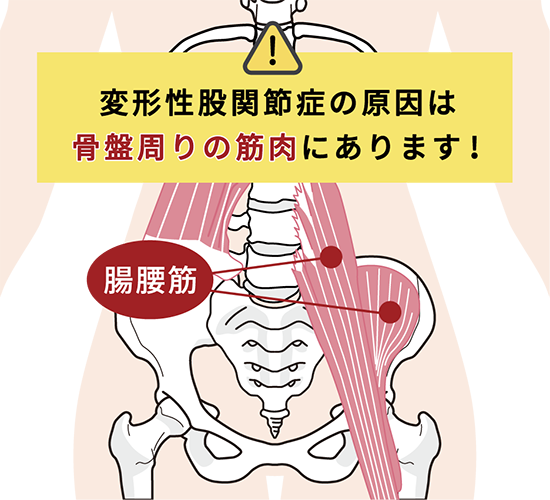 骨盤の歪みが股関節に負担をかける図解