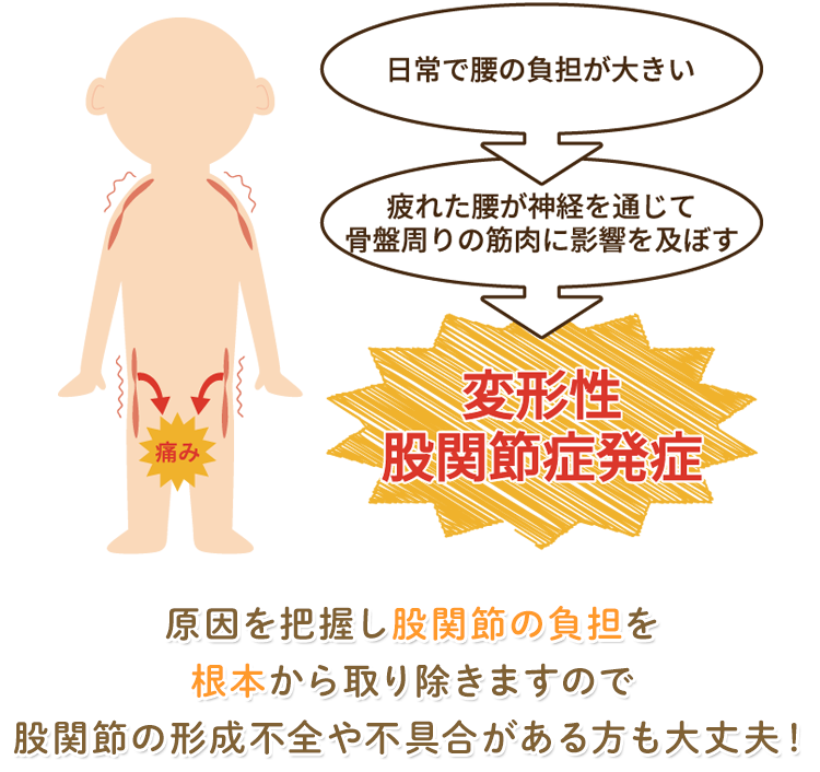 腰やお尻の筋肉の硬直が痛みを引き起こす図解