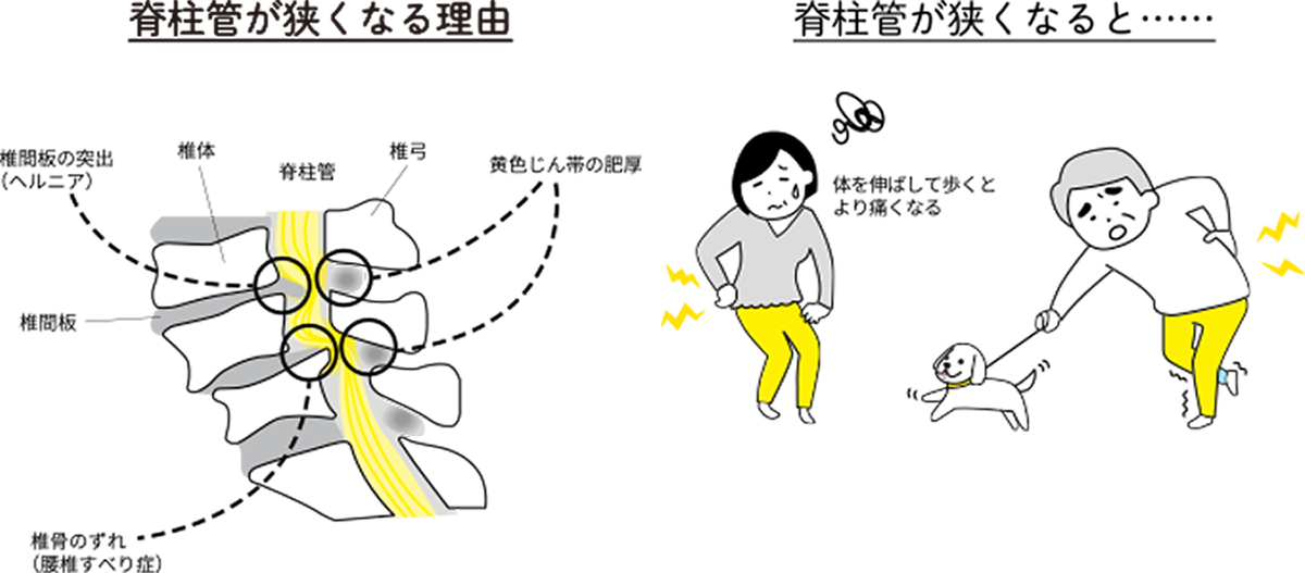 脊柱管狭窄症の3つの原因：神経の圧迫・血流障害・炎症