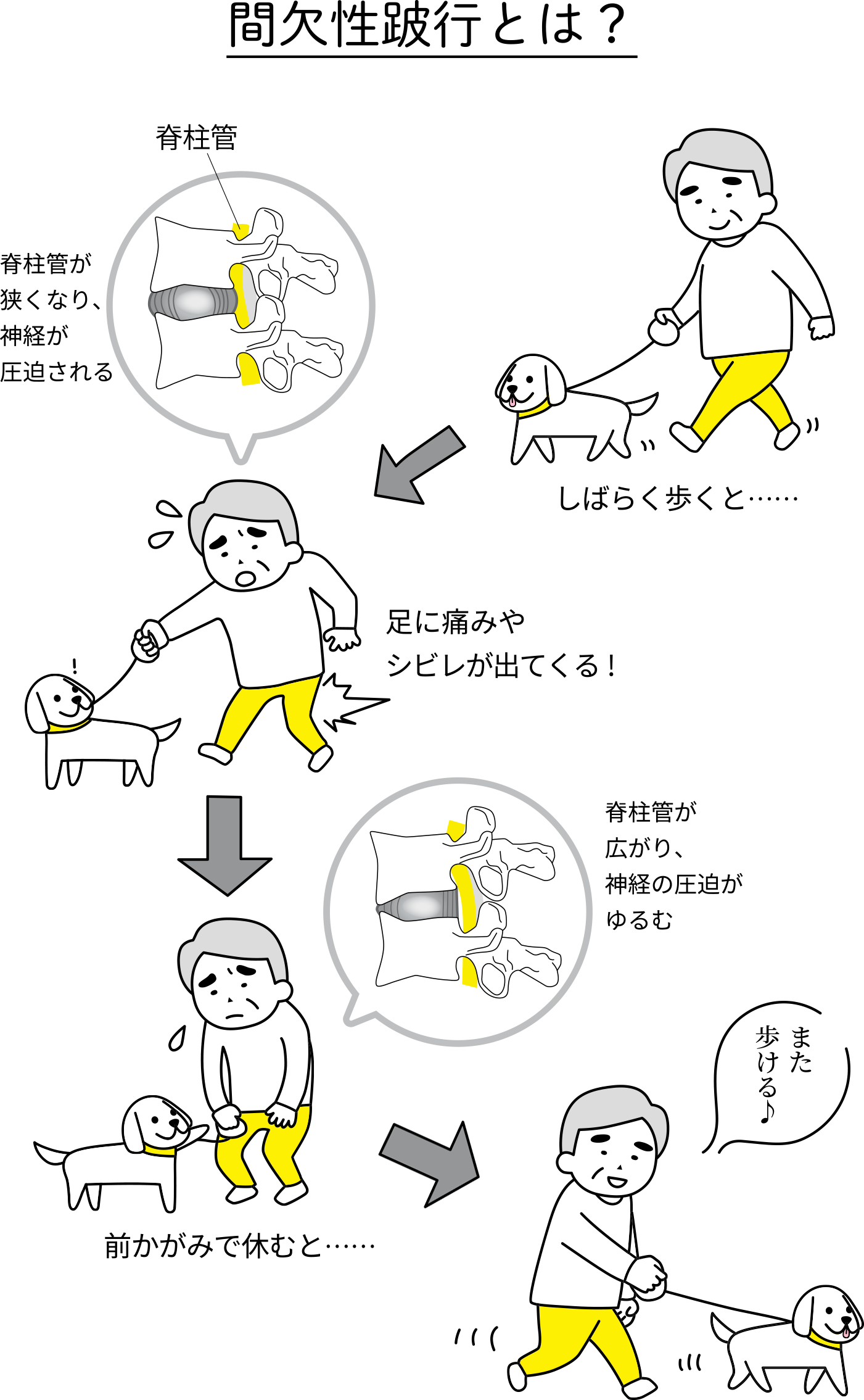 脊柱管狭窄症の代表的な症状である間欠性跛行（歩くと痛み、前かがみで楽になる）の仕組みを図解したイラスト