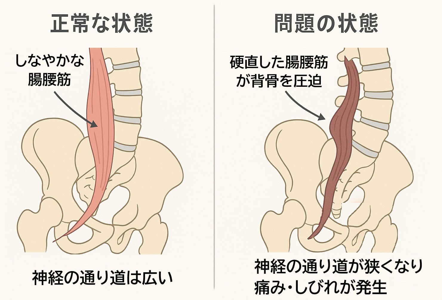 脊柱管狭窄症の本当の原因である硬直した腸腰筋が神経を圧迫するメカニズムを図解したイラスト