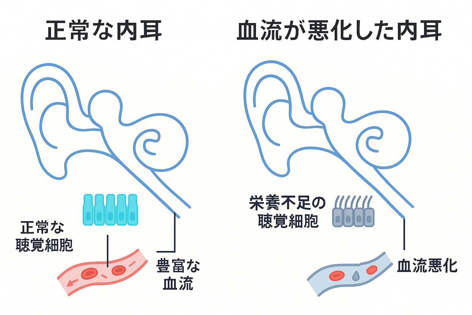 突発性難聴の原因となる正常な内耳と血流が悪化した内耳の比較図解