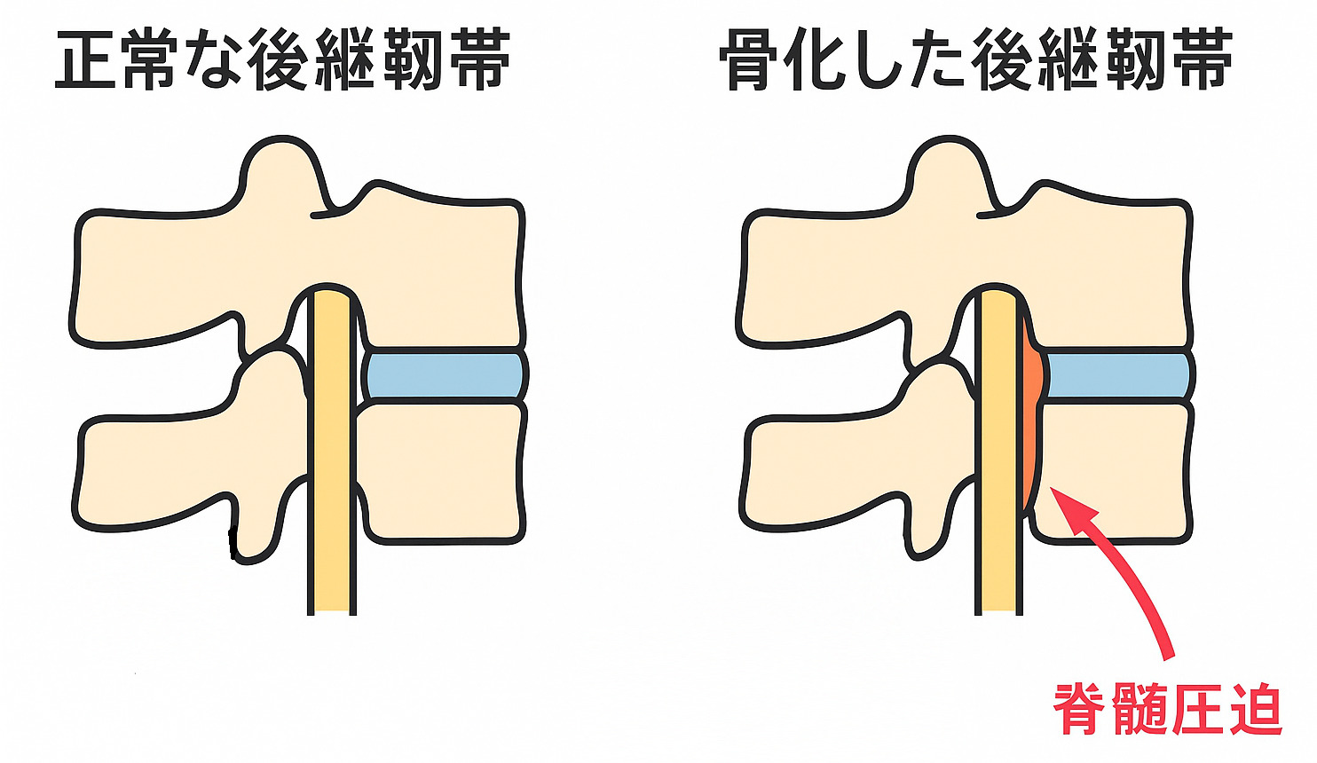 後縦靭帯骨化症(OPLL)による脊髄圧迫のメカニズムを示したイラスト