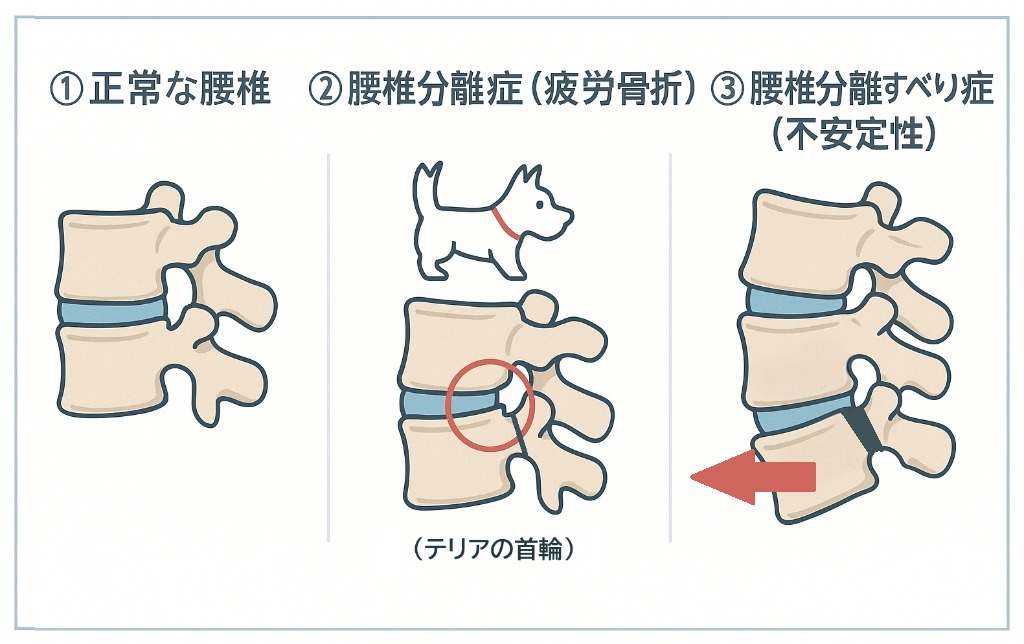 腰椎分離症とすべり症の病態生理を解説するイラスト。正常な腰椎、疲労骨折した分離症（スコッチテリア犬の首輪）、前方にずれたすべり症の3段階を示しています。