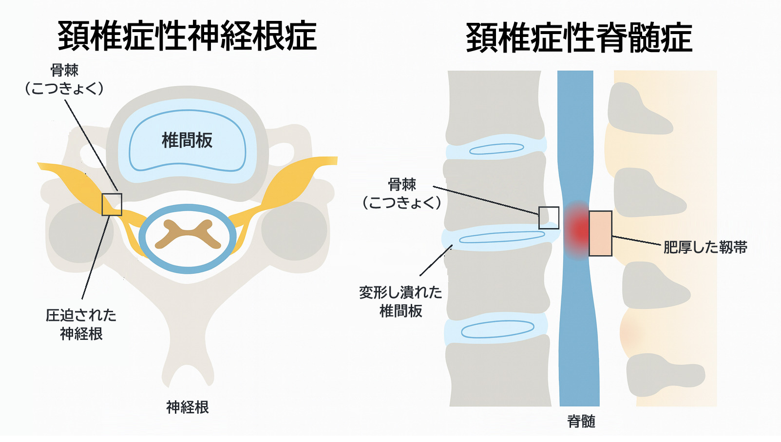 頚椎症性神経根症と頚椎症性脊髄症の違いを比較したイラスト。圧迫部位と症状の範囲を図解。