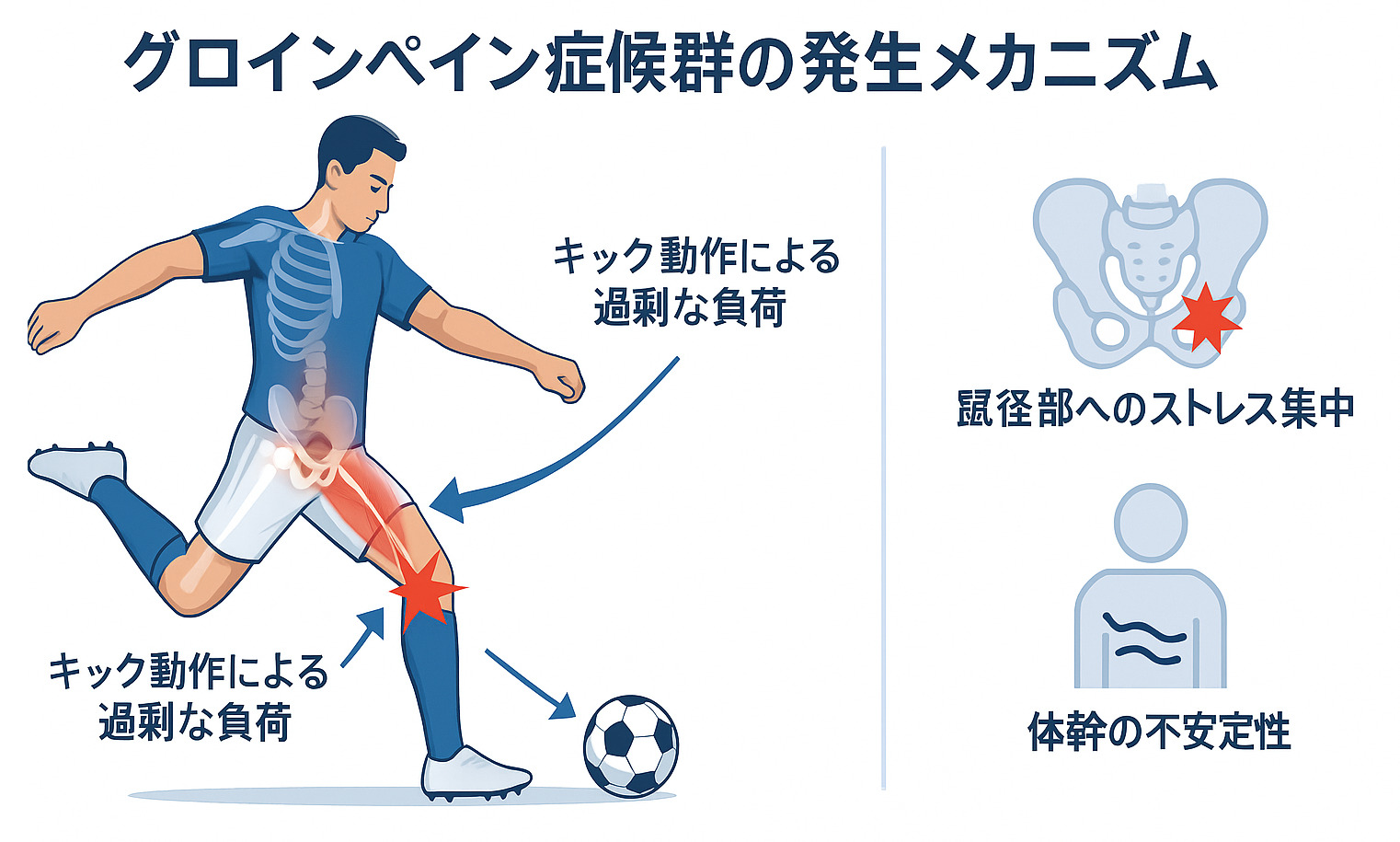 グロインペイン症候群の発生メカニズムを図解するイラスト。キック動作による負荷と体幹の不安定性が、鼠径部へのストレス集中を引き起こす様子を示している。