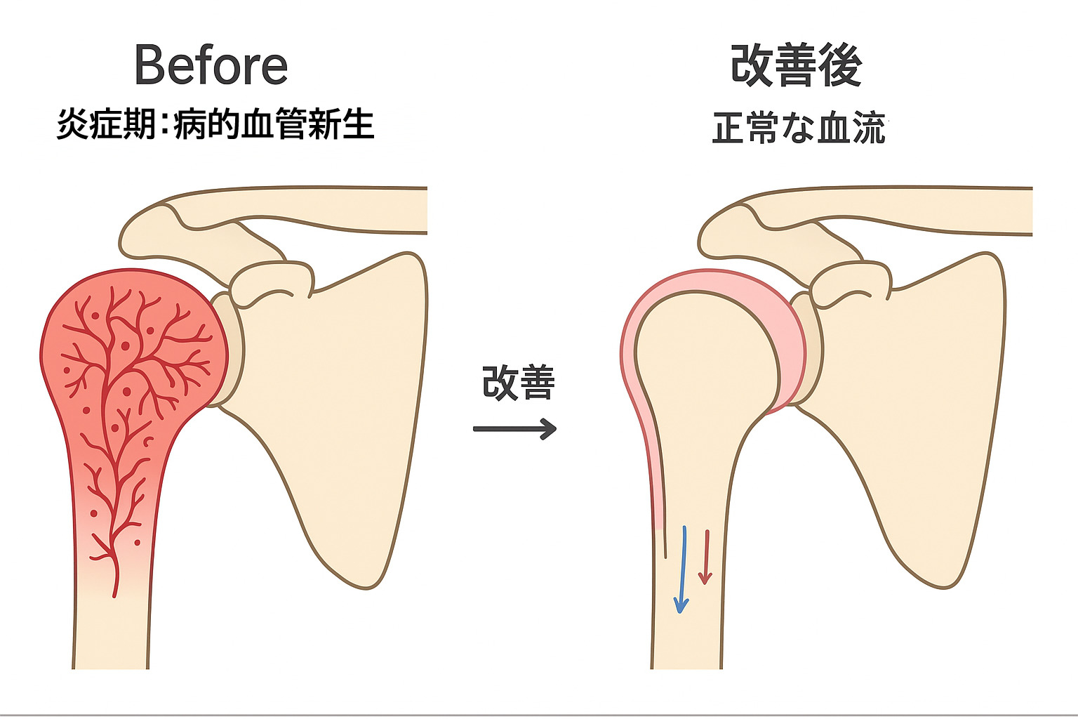 鍼治療による四十肩・五十肩の血流正常化のイメージ図：炎症期の病的血管新生から正常な血流へ