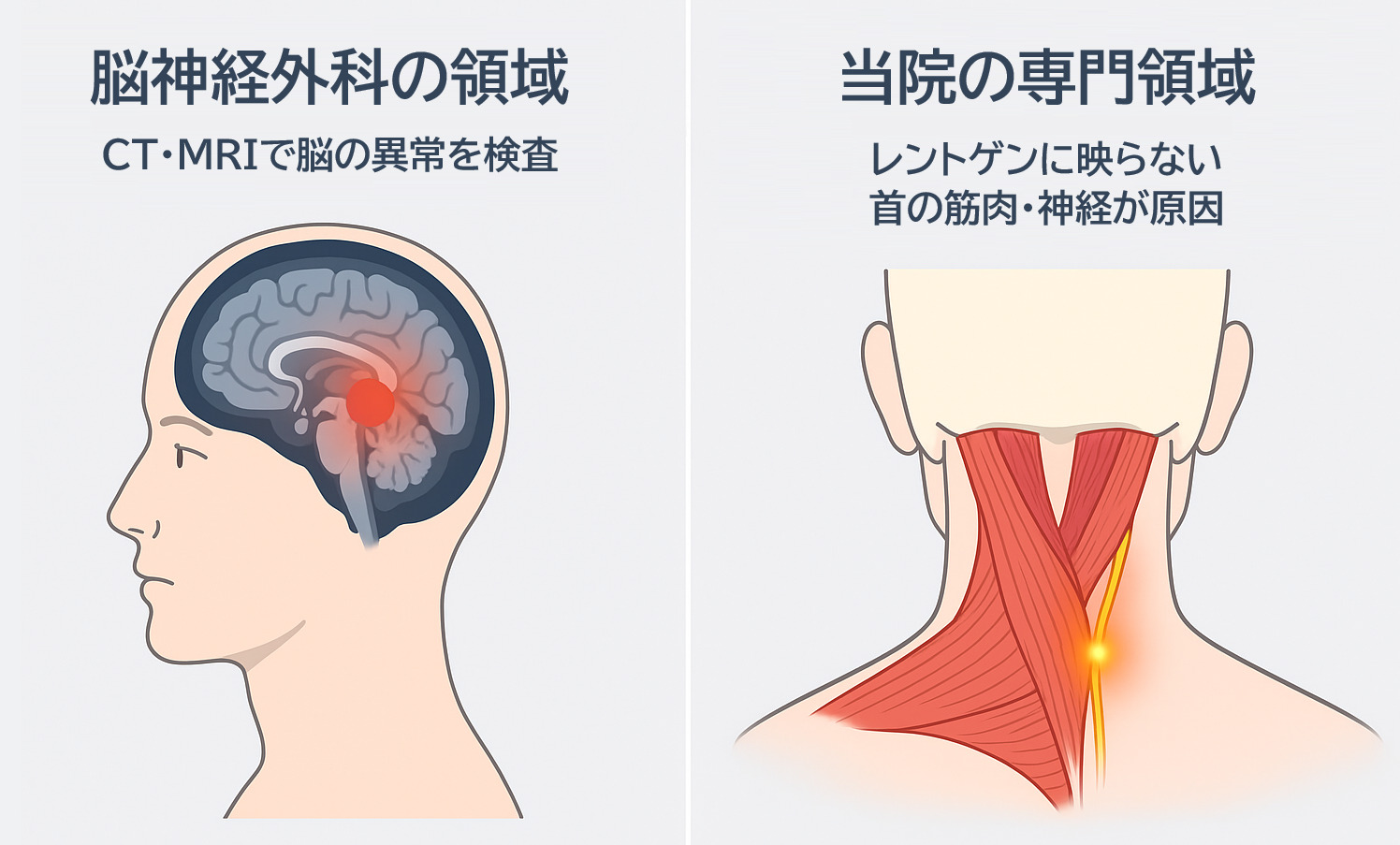 頭痛の原因：脳神経外科が検査する「脳の異常」と、鍼灸整骨院がアプローチする「首の筋肉・神経の問題」との違いを示す図解