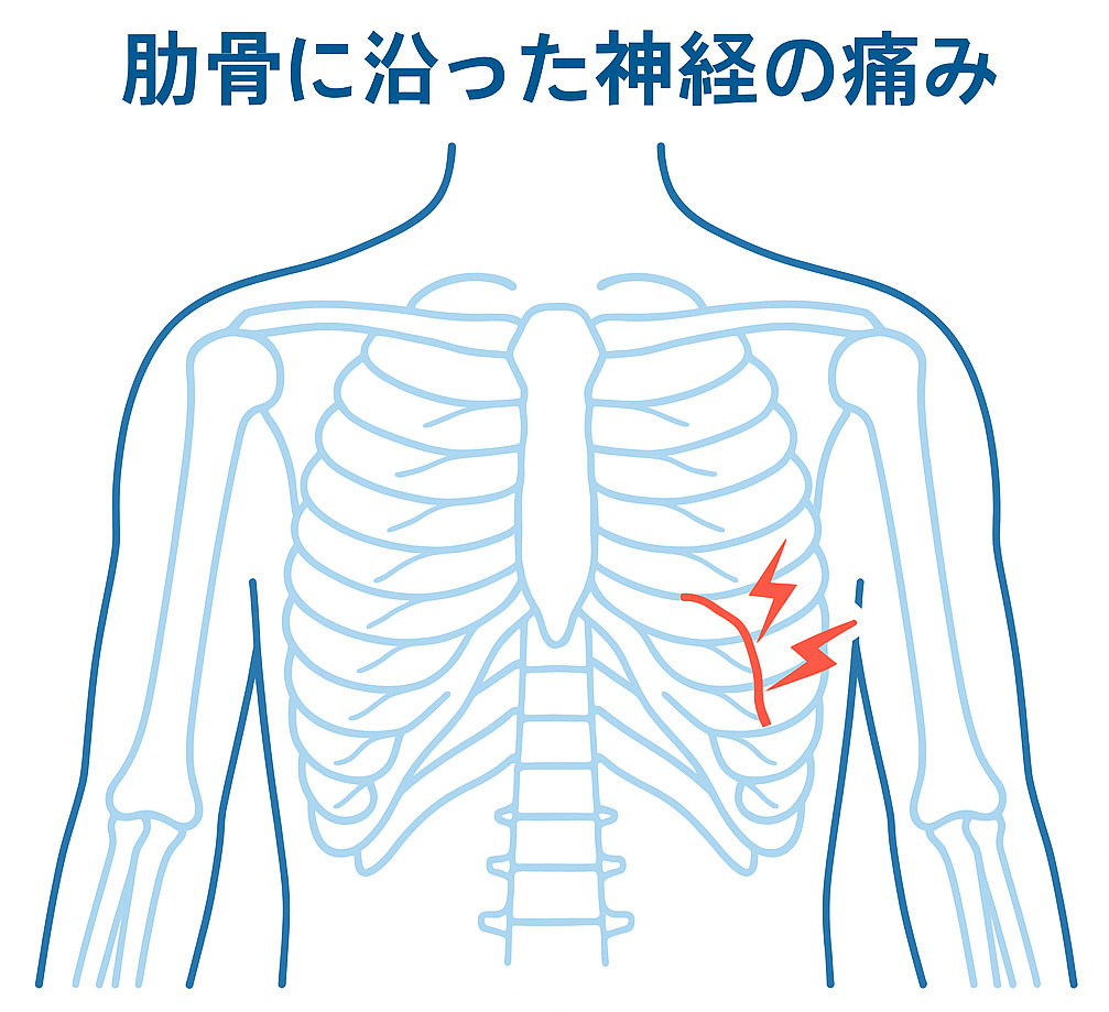 肋間神経痛の痛みの場所を示すイラスト。肋骨に沿って走る神経が赤くハイライトされ、痛みの箇所を図解しています。