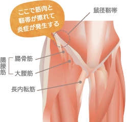 グロインペイン症候群の原因解説図。腸腰筋と鼠径靭帯が擦れて炎症が起きる様子が示されている。